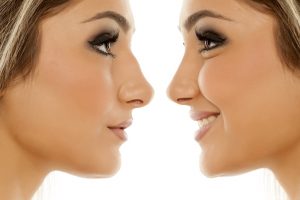 Non-Surgical Rhinoplasty