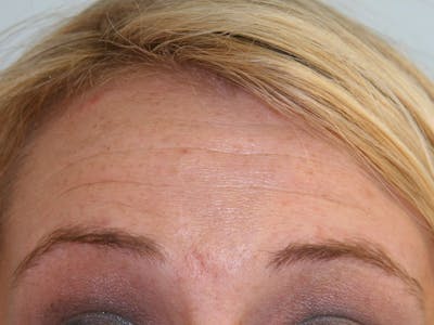 BOTOX Before & After Gallery - Patient 143511015 - Image 1