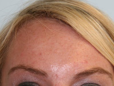 BOTOX Before & After Gallery - Patient 143511015 - Image 2