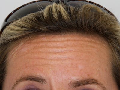 BOTOX Before & After Gallery - Patient 143511019 - Image 1