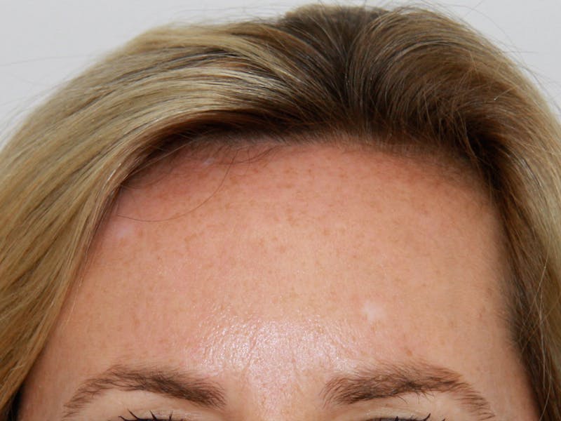 BOTOX Before & After Gallery - Patient 143511019 - Image 2