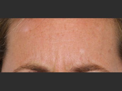 BOTOX Before & After Gallery - Patient 143511023 - Image 1