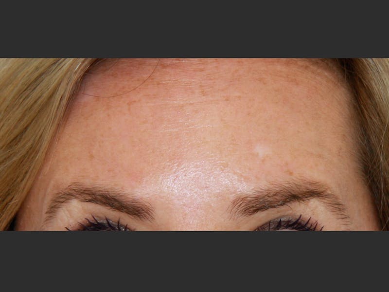 BOTOX Before & After Gallery - Patient 143511023 - Image 2