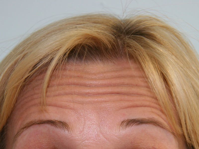 BOTOX Before & After Gallery - Patient 143511026 - Image 1