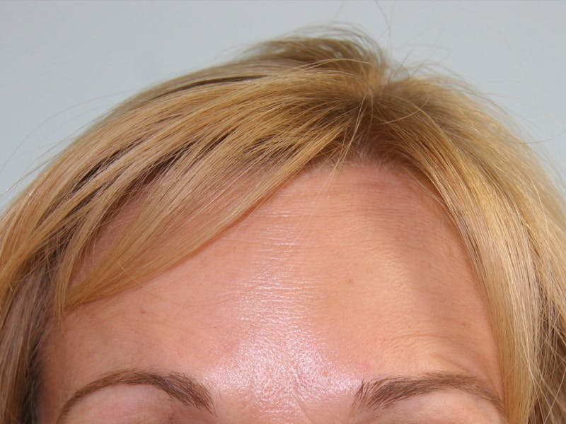 BOTOX Before & After Gallery - Patient 143511026 - Image 2