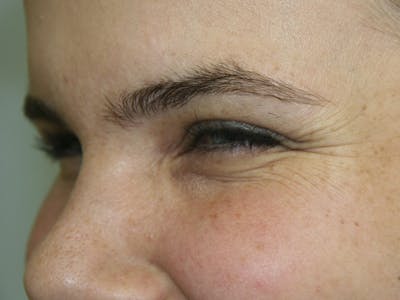 BOTOX Before & After Gallery - Patient 143511030 - Image 1