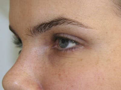 BOTOX Before & After Gallery - Patient 143511030 - Image 2