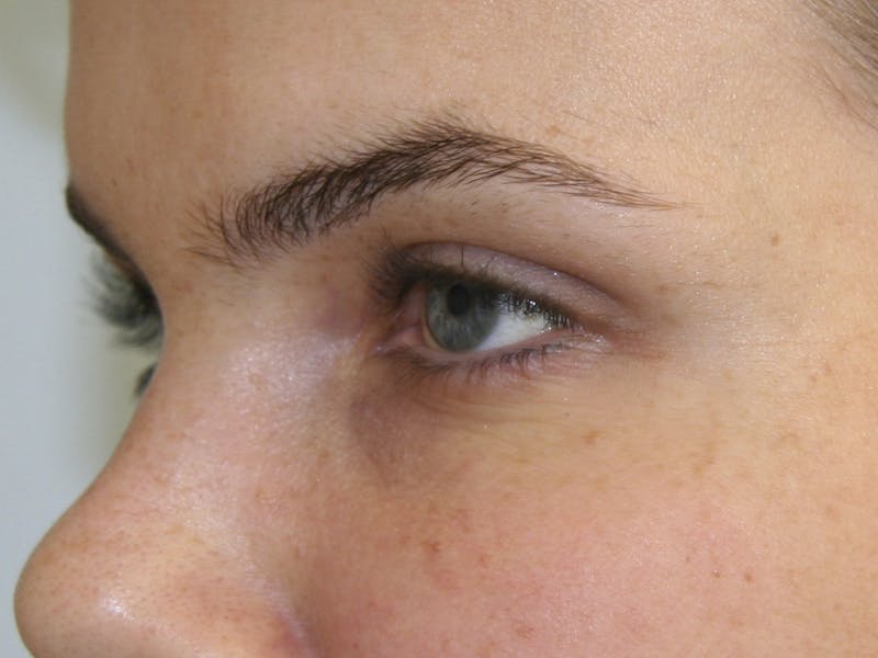 BOTOX Before & After Gallery - Patient 143511030 - Image 2
