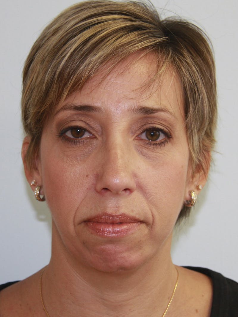 Chin Augmentation Before & After Gallery - Patient 143511058 - Image 1