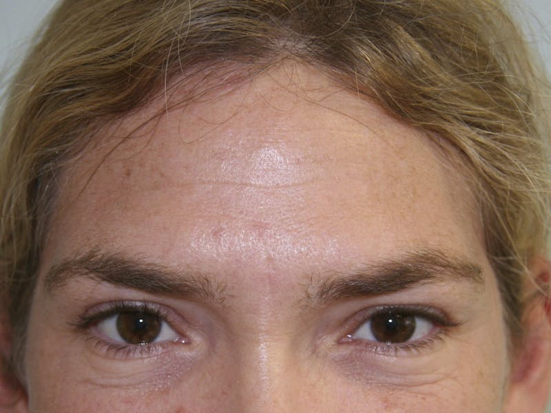 BOTOX Before & After Gallery - Patient 143511052 - Image 1
