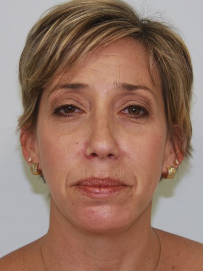 Chin Augmentation Before & After Gallery - Patient 143511058 - Image 2