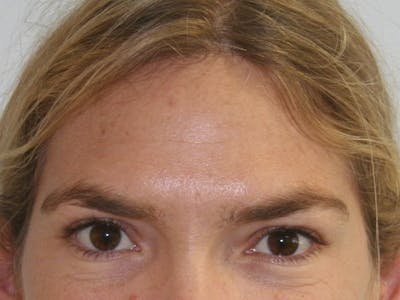 BOTOX Before & After Gallery - Patient 143511052 - Image 2
