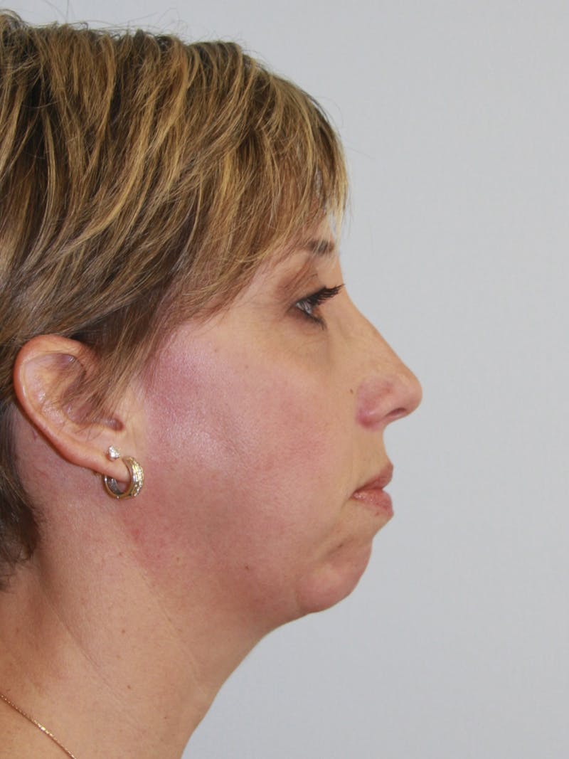Chin Augmentation Before & After Gallery - Patient 143511058 - Image 3