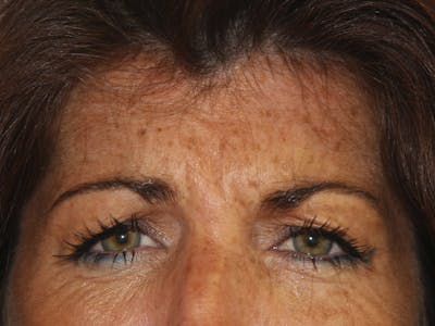 BOTOX Before & After Gallery - Patient 143511060 - Image 1