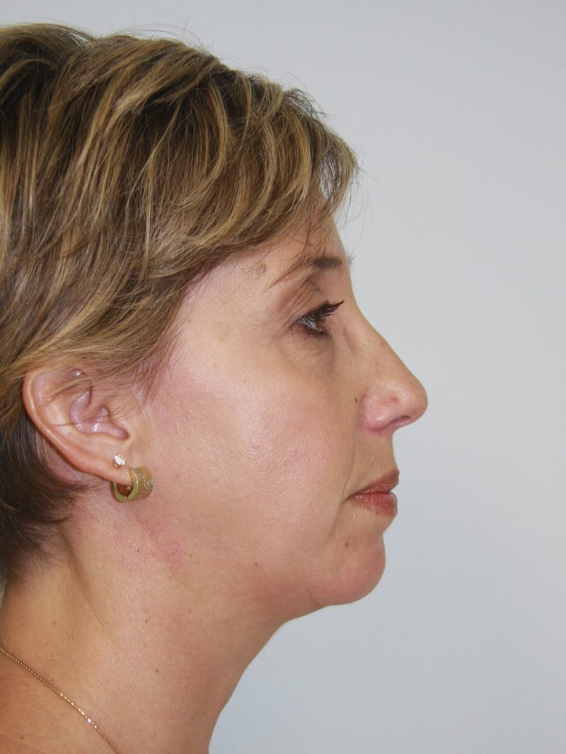 Chin Augmentation Before & After Gallery - Patient 143511058 - Image 4