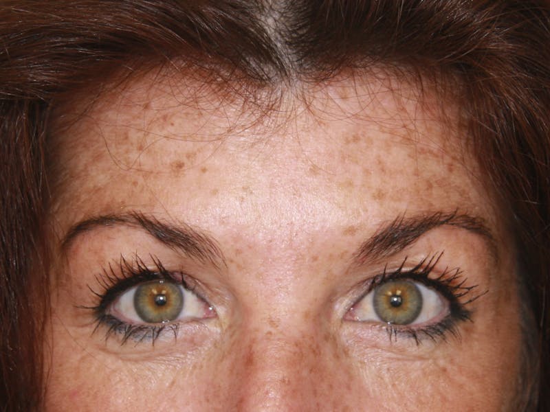 BOTOX Before & After Gallery - Patient 143511060 - Image 2