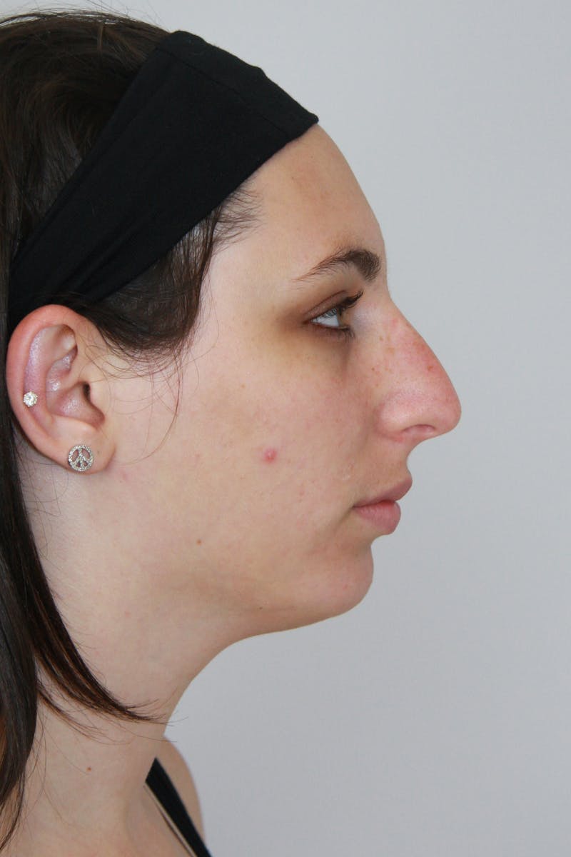 Chin Augmentation Before & After Gallery - Patient 143511066 - Image 1