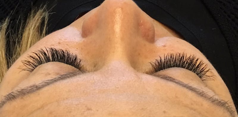 Eyelash Extensions Before & After Gallery - Patient 143511061 - Image 2