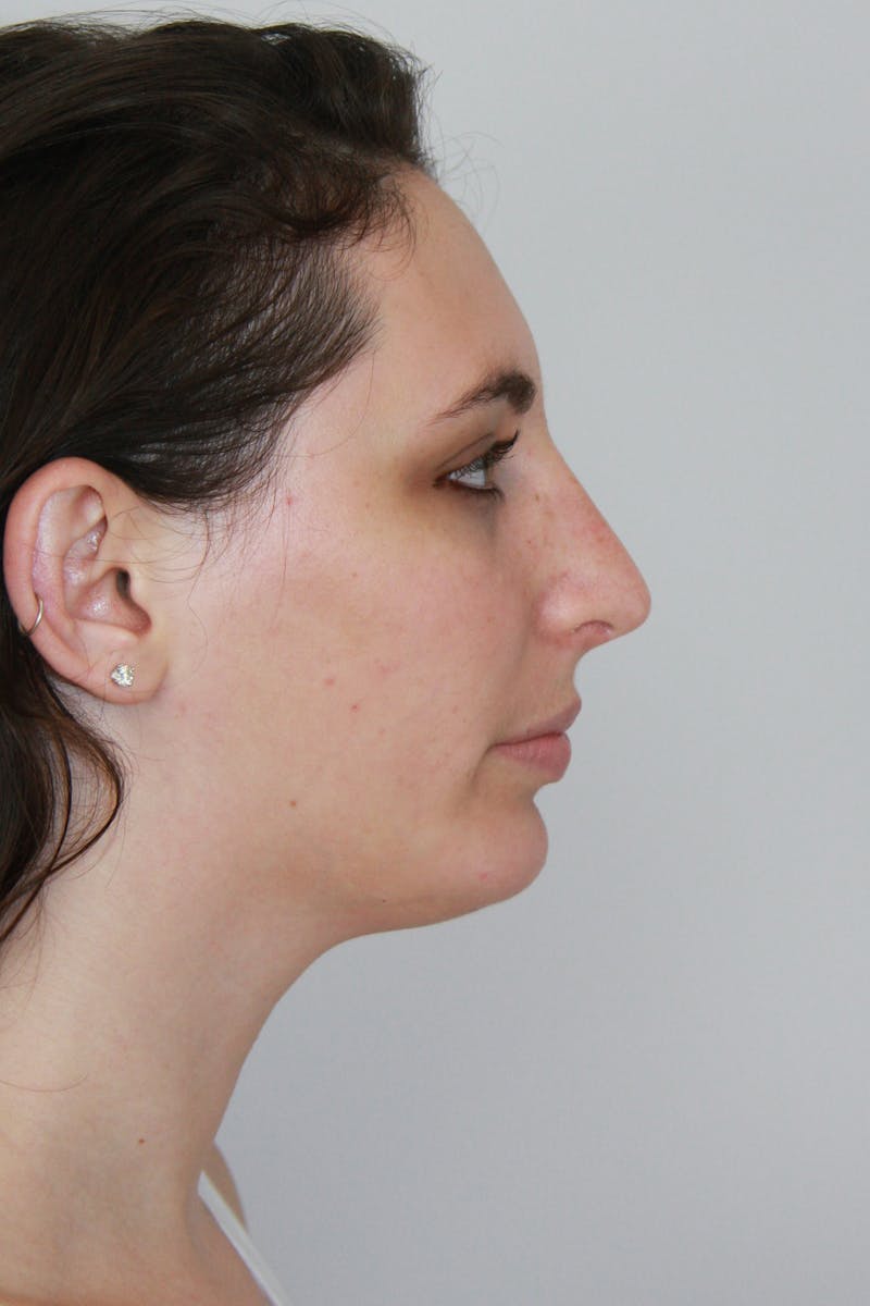 Chin Augmentation Before & After Gallery - Patient 143511066 - Image 2