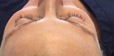 Eyelash Extensions Before & After Gallery - Patient 143511062 - Image 1