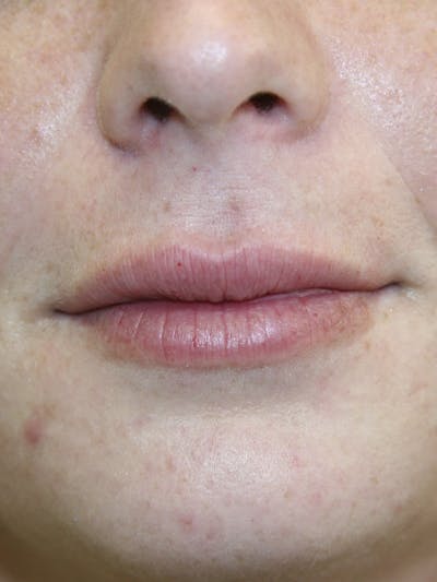 Juvederm Before & After Gallery - Patient 143511063 - Image 1