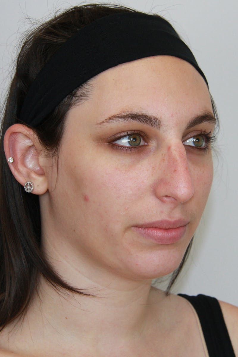 Chin Augmentation Before & After Gallery - Patient 143511066 - Image 3