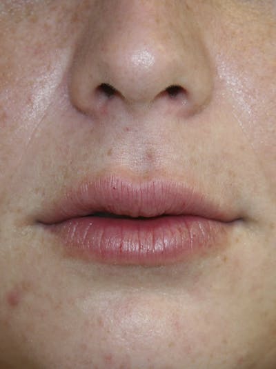 Juvederm Before & After Gallery - Patient 143511063 - Image 2