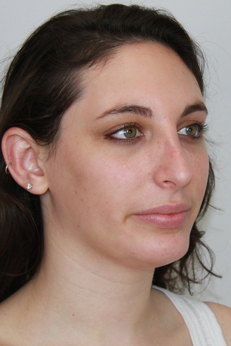 Chin Augmentation Before & After Gallery - Patient 143511066 - Image 4