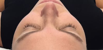 Eyelash Extensions Before & After Gallery - Patient 143511065 - Image 1