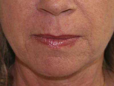 Juvederm Before & After Gallery - Patient 143511064 - Image 1