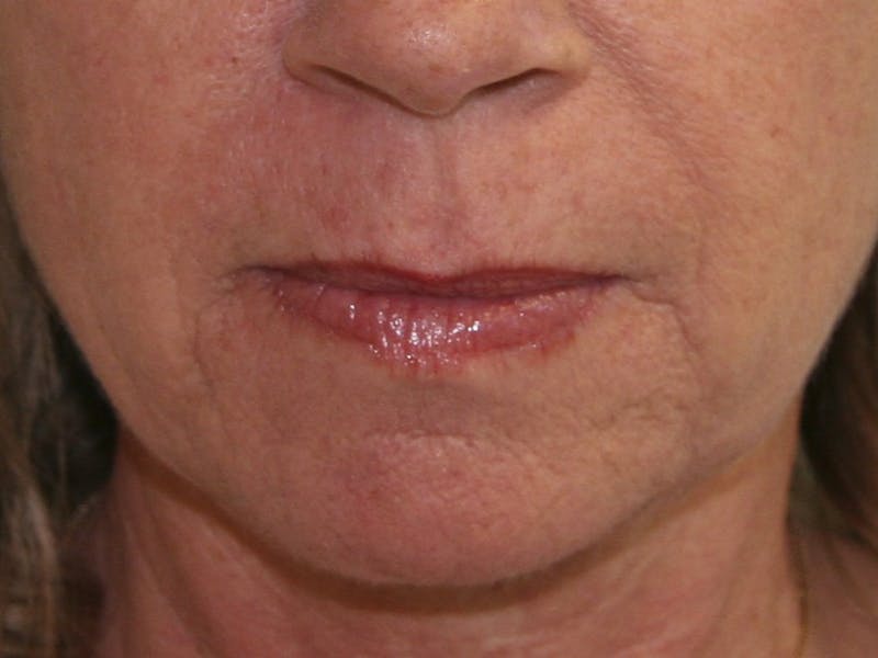 Juvederm Before & After Gallery - Patient 143511064 - Image 1