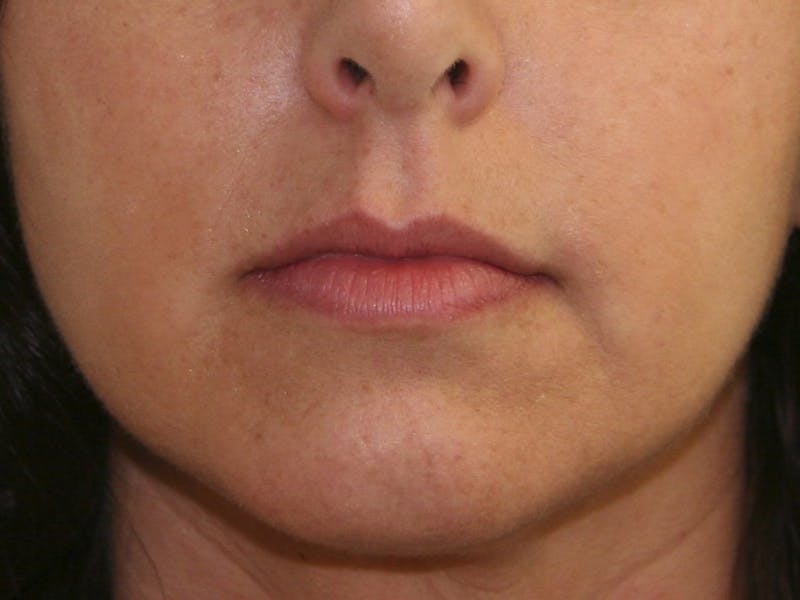 Lip Augmentation Before & After Gallery - Patient 143511067 - Image 1