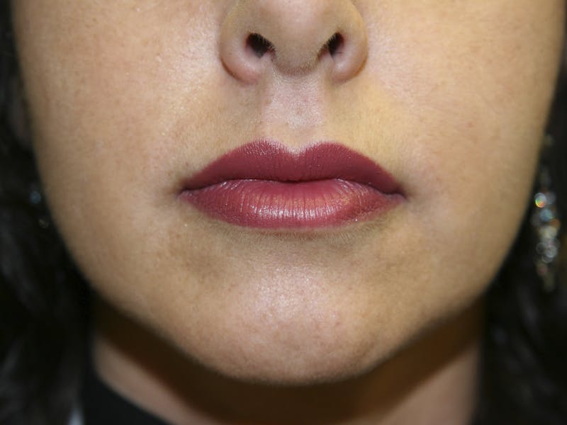 Lip Augmentation Before & After Gallery - Patient 143511067 - Image 2