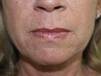 Juvederm Before & After Gallery - Patient 143511064 - Image 2