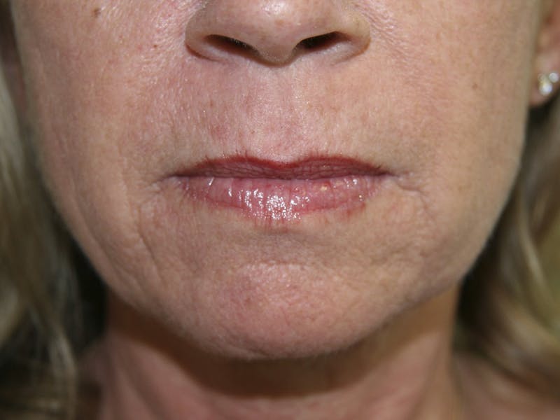 Juvederm Before & After Gallery - Patient 143511064 - Image 2