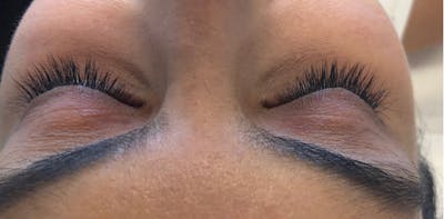Eyelash Extensions Before & After Gallery - Patient 143511071 - Image 1