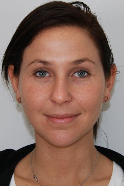 Chin Augmentation Before & After Gallery - Patient 143521843 - Image 1