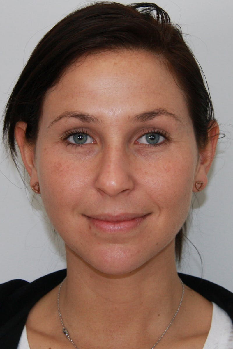 Chin Augmentation Before & After Gallery - Patient 143521843 - Image 1