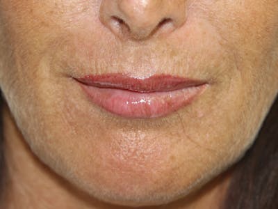 Lip Augmentation Before & After Gallery - Patient 143511073 - Image 1