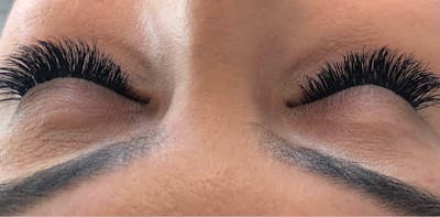 Eyelash Extensions Before & After Gallery - Patient 143511071 - Image 2