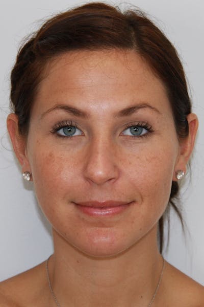 Chin Augmentation Before & After Gallery - Patient 143521843 - Image 2