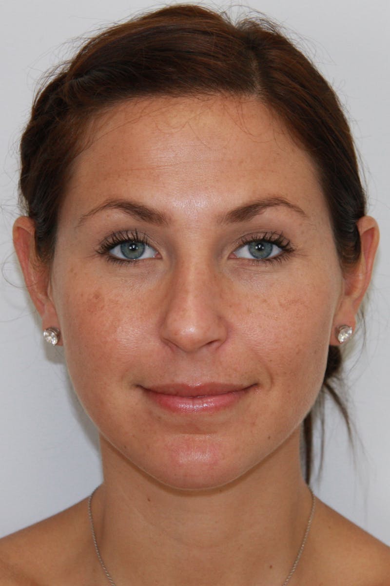 Chin Augmentation Before & After Gallery - Patient 143521843 - Image 2