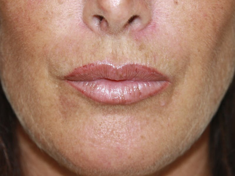 Lip Augmentation Before & After Gallery - Patient 143511073 - Image 2