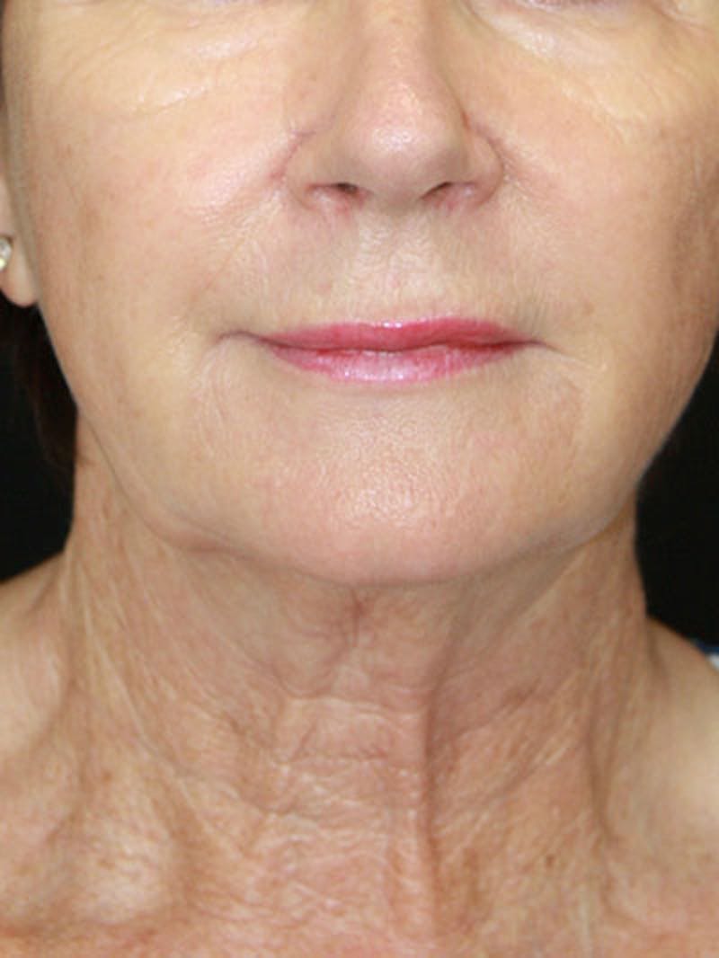 Facelift & Neck Lift Before & After Gallery - Patient 143521841 - Image 1