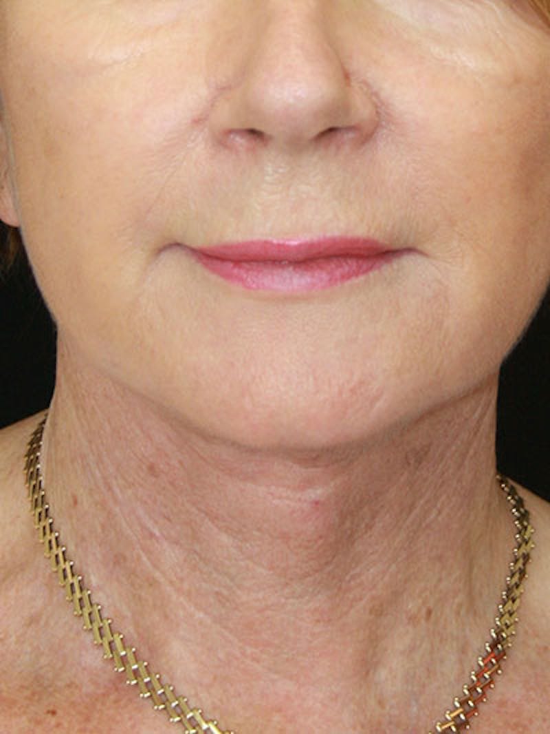 Facelift & Neck Lift Before & After Gallery - Patient 143521841 - Image 2