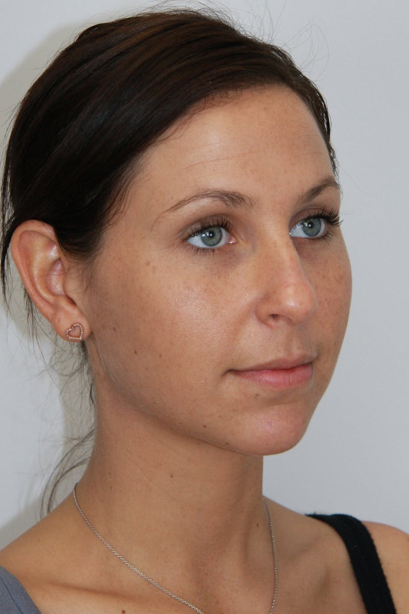 Chin Augmentation Before & After Gallery - Patient 143521843 - Image 3