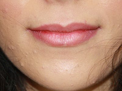 Lip Augmentation Before & After Gallery - Patient 143521833 - Image 1