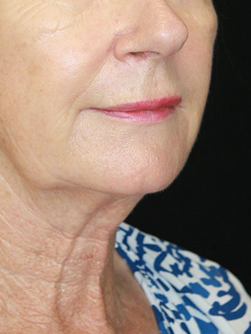 Facelift & Neck Lift Before & After Gallery - Patient 143521841 - Image 3
