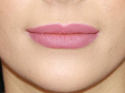 Lip Augmentation Before & After Gallery - Patient 143521833 - Image 2
