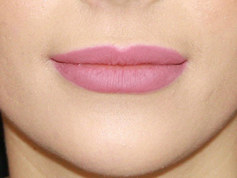 Lip Augmentation Before & After Gallery - Patient 143521833 - Image 2